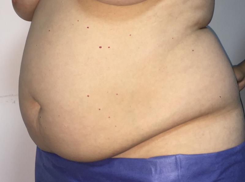Smart $D High Definition Liposuction, Abdominal Liposuction, Vaser Lipo, Cosmeti