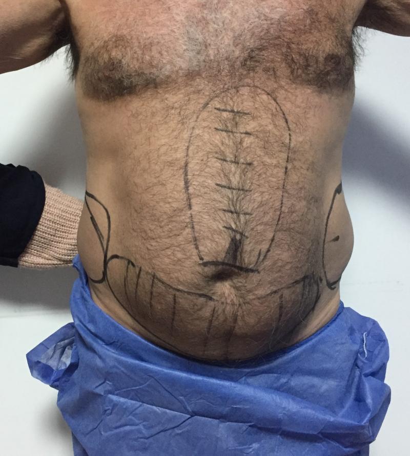 Smart Lipo, High Definition Liposuction, Vaser Liposuction, Flank Liposuction