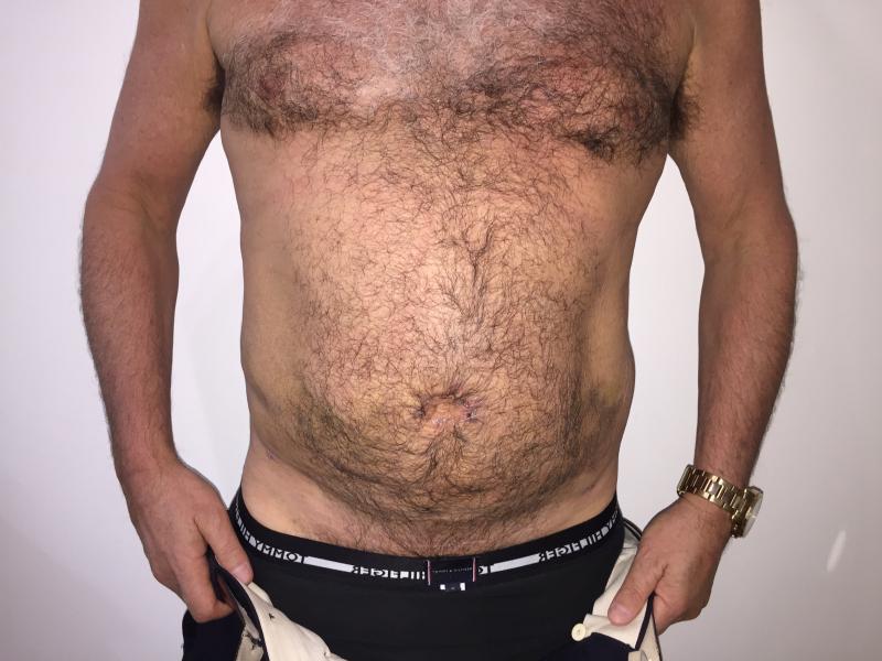4-D Liposuctio, High Definition Liposuction, Vaser Liposuction, Flank Liposuctio