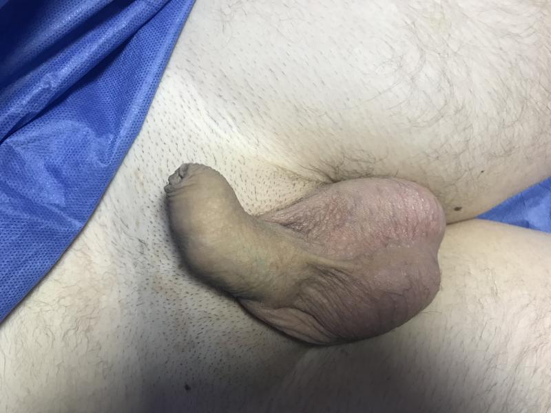 Small Penis, Bent Penis, Fat Injection Penis, Fat Grafting Penis, Skin Grafting