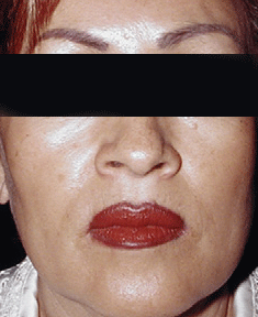 Cosmetic Surgery Egypt, Face Lift, Stem Cells, Aesthetic Surgery Egypt, Neck