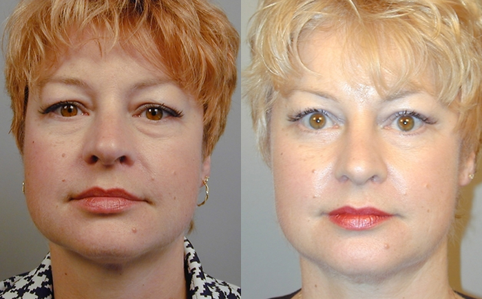 Fat Injection Face Lift, Stem Cell Face Lift, Nano fat injection face lift