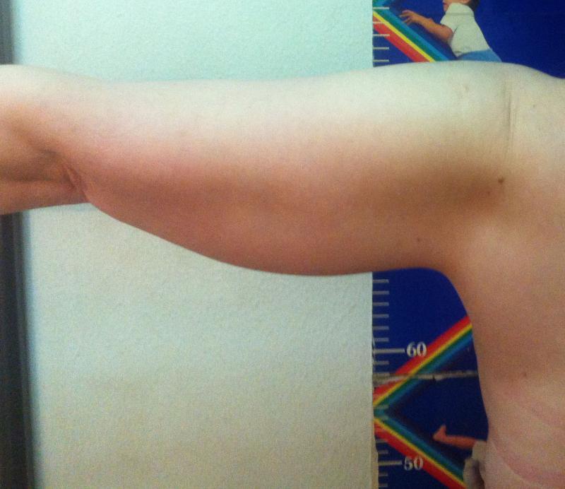 Arm Laser Liposuction, Arm Lift, Laser Liposuction Egypt, Best Plastic Surgeon