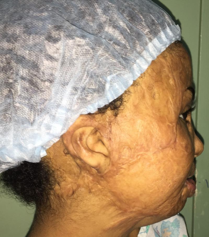 Best Cosmetic Surgery Egypt, Face Surgery, Cheek Surgery, Burn Scar, Face Lift