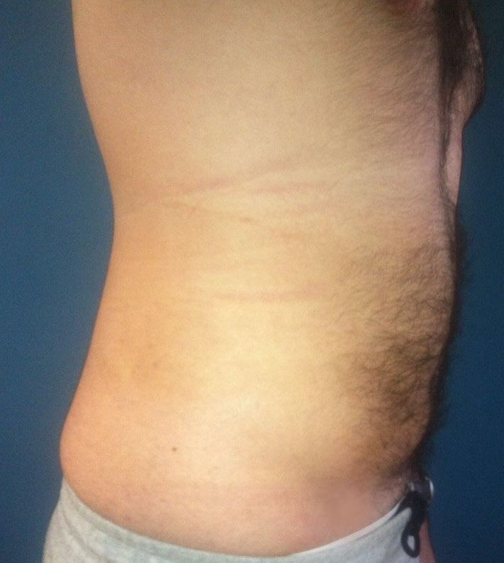 Laser Liposuction, Smart Liposuction, High Definition Liposculpture, Plastic Sur
