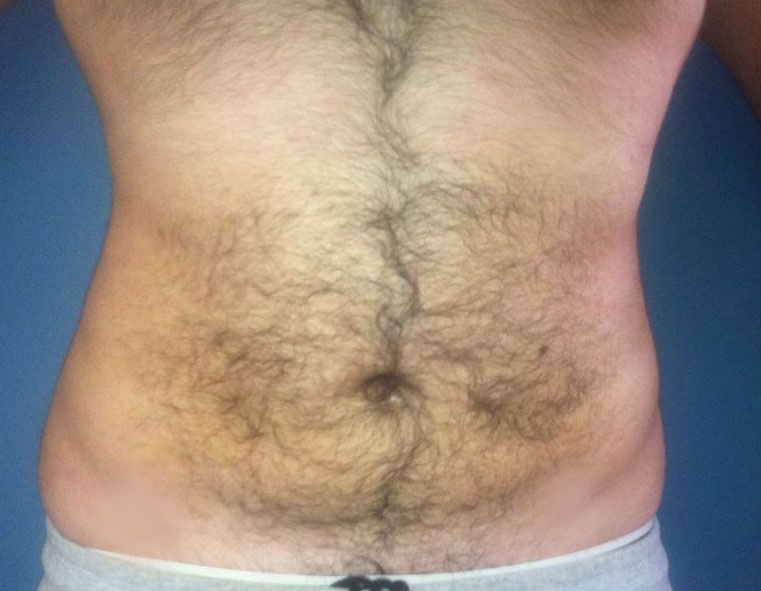 Laser Liposuction, Smart Liposuction, High Definition Liposculpture, Cosmetic Su