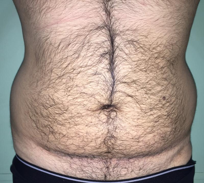 Vaser Liposuction, Smart Liposuction, High Definition Liposculpture, Cosmetic Su