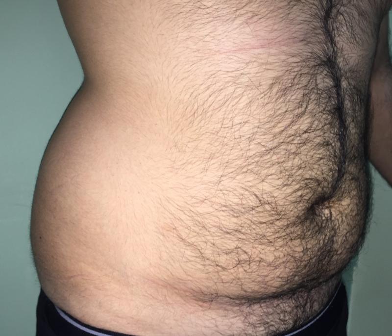 Vaser Liposuction, Smart Liposuction, High Definition Liposculpture, Plastic Sur