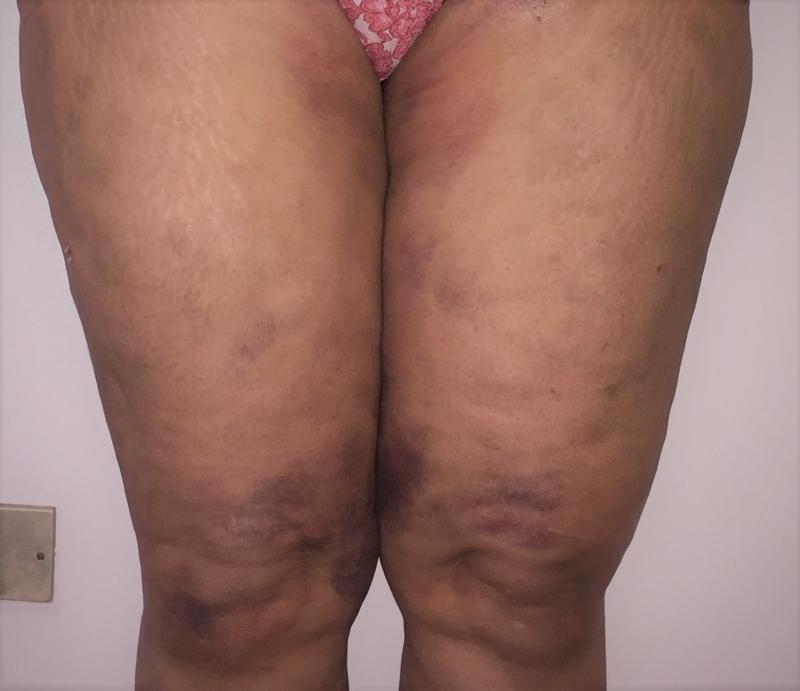 Thigh Vaser 4 D Liposuction, Inner thigh Liposuction, Cellulite removal, Cosmeti