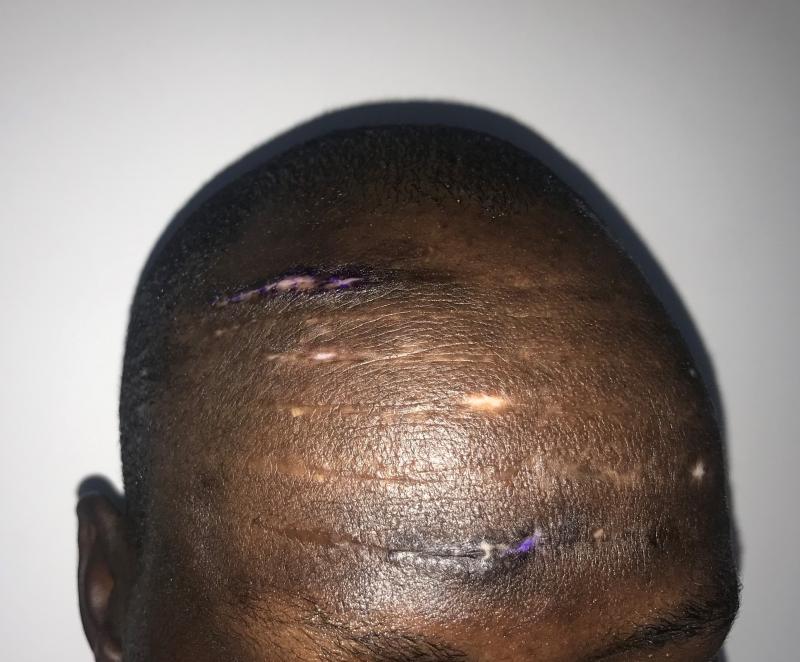 Stem Cells and fat Injection for Tribal Mark Scars at Best Cosmetic Surgery Egyp