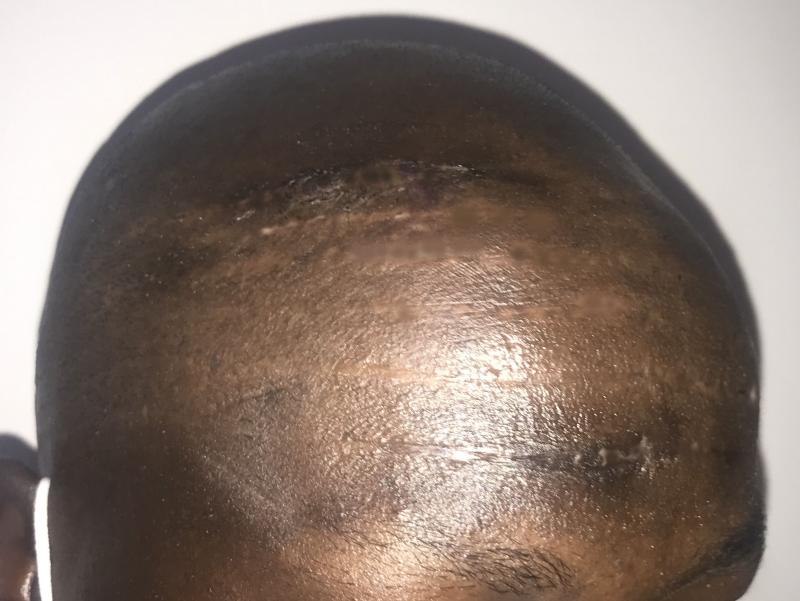 Stem Cells and fat Injection for Tribal Mark Scars at Best Plastic Surgery Egypt