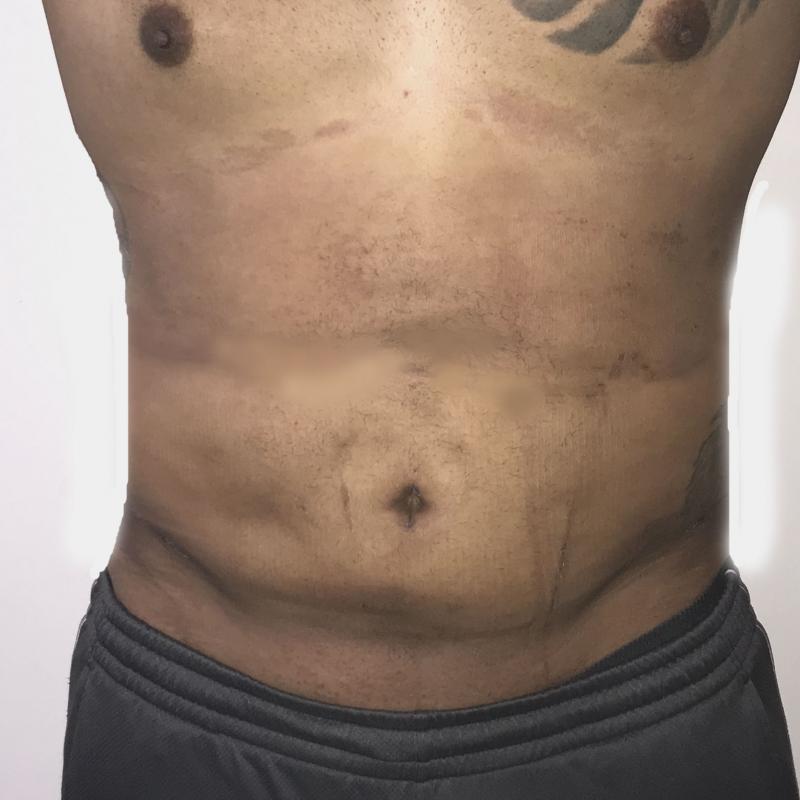 Smart High Definition 4 Dimensional Vaser Liposuction at Best Cosmetic Surgery