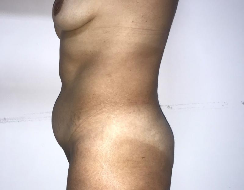 Tummy smart Vaser High Definition Liposuction at Best Plastic Surgery Egypt