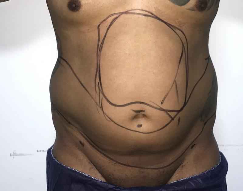 Smart High Definition 4 Dimensional Vaser Liposuction at Best Plastic Surgery Eg