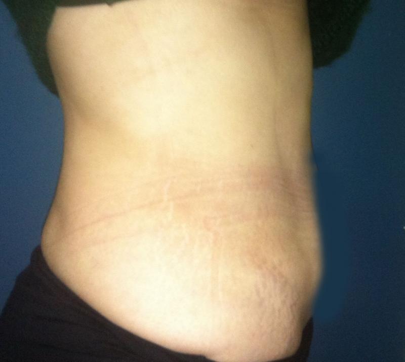 Laser Liposculpture Egypt, Vaser Liposuction Obesity, Best Plastic Surgery Egyp