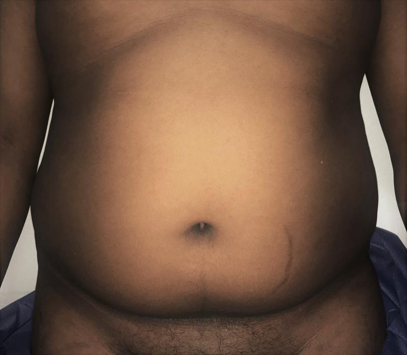 Tummy Liposuction, Abdomen Liposuction, 4D Liposuction, High Definition Liposuct