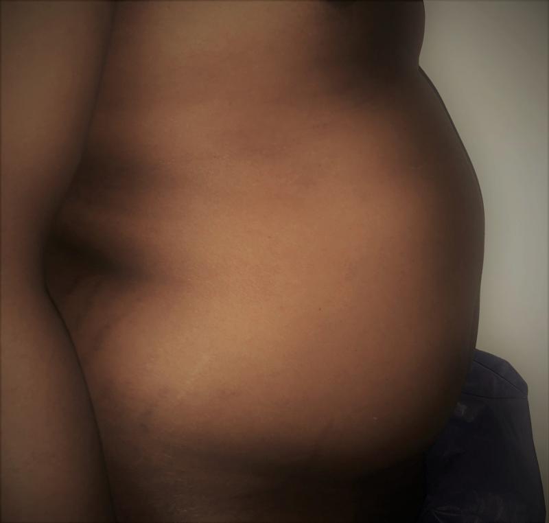 Tummy Liposuction, Abdomen Liposuction, 4D Liposuction, HD Liposuction, Plastic