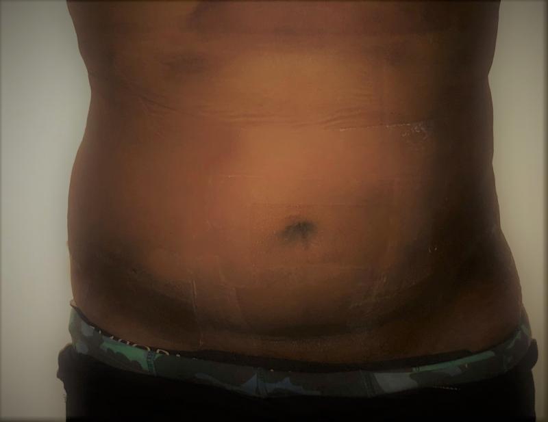 Tummy Liposuction, Abdomen Liposuction, 4D Liposuction, HD Liposuction, Cosmetic