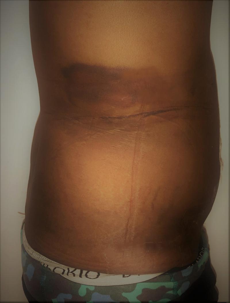 VASER 4D Hi-Def Lipo of the Flank - Liposuction of the Flanks