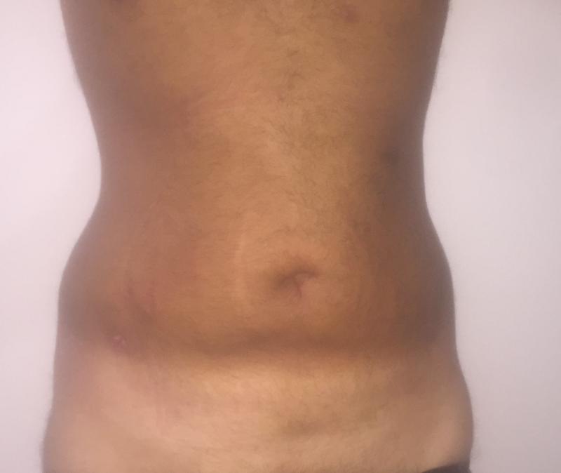 Vaser Liposuction, 4D Liposuction, High Definition Liposuction, Tummy Liposuctio