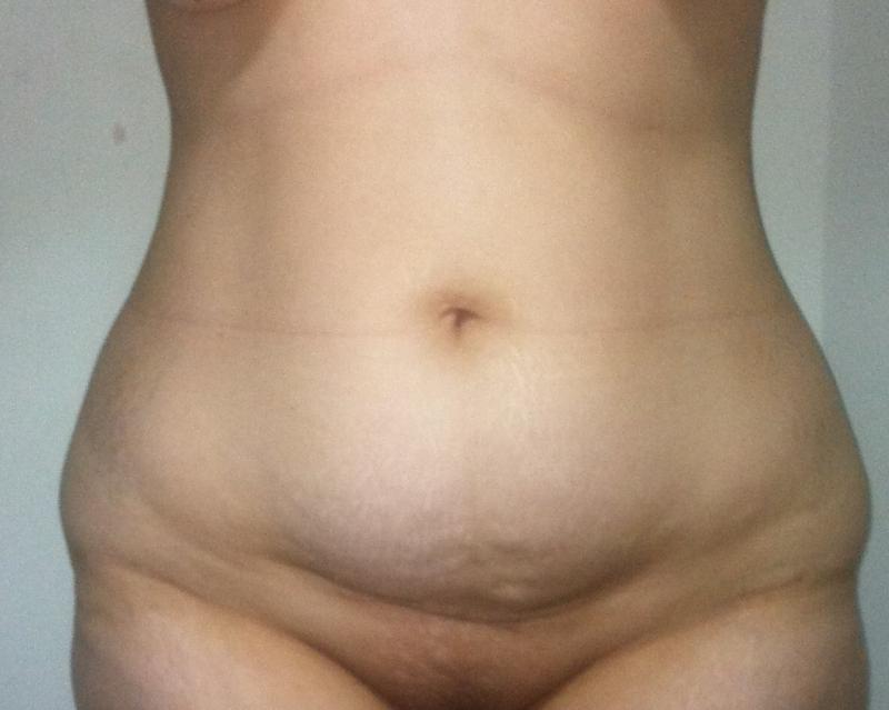 Vaser Liposculpture Egypt, Laser Liposuction Egypt, Best Plastic Surgery Egypt