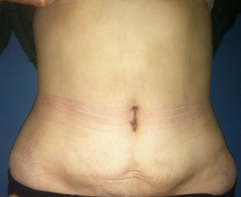 Vaser Liposculpture Egypt, Laser Liposuction Egypt, Best Cosmetic Surgery Egypt