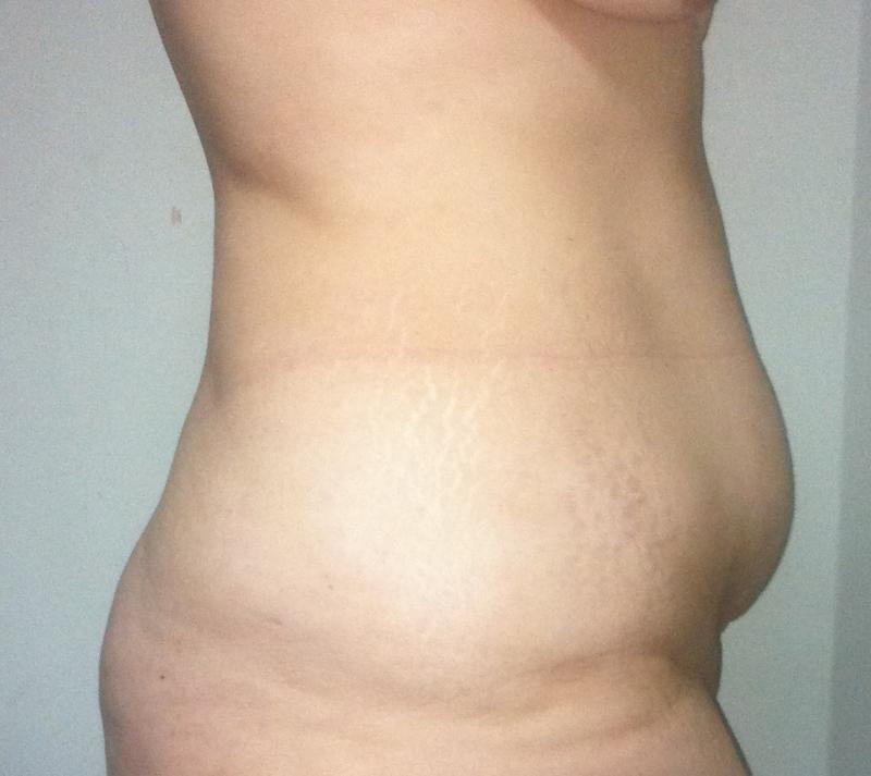 Laser Liposculpture Egypt, Vaser Liposuction Obesity, Best Cosmetic Surgery Egyp