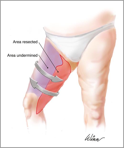 Thigh lift, Thigh Liposuction, Vertica thigh lift, Obesity, Best Plastic Surgery