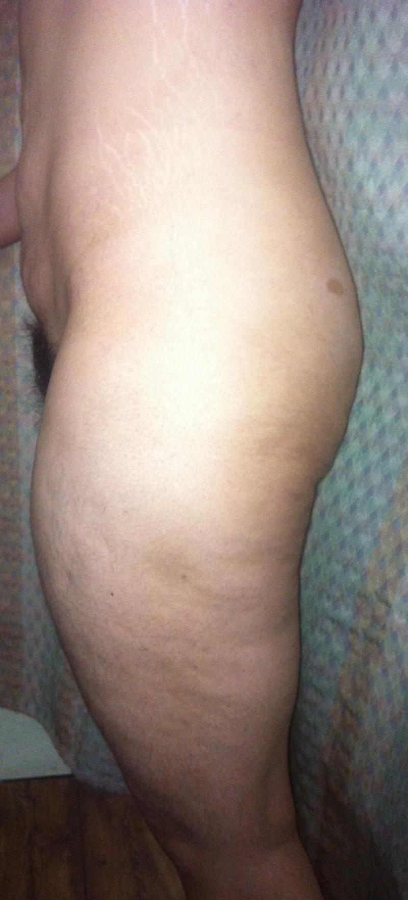 Thigh Lift Egypt, Morbid Obesity Egypt, Vertical Thigh Lift, Laser Liposuction