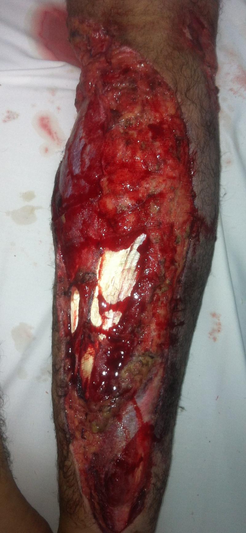 Best Cosmetic Surgery Egypt, Leg surgery, Leg cover, Calf liposuction