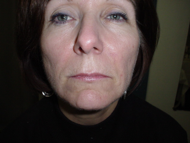Aesthetic Surgery Egypt, Fat injection, Stem Cells, Plastic Surgery Egypt