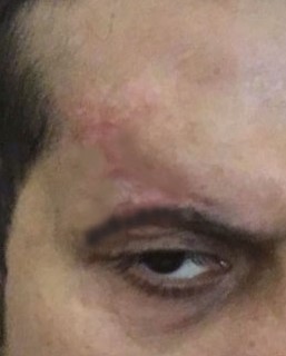 Best Cosmetic Surgeon, FUE Hair Transplantation, Stem Cell Therapy, Scar Revisio