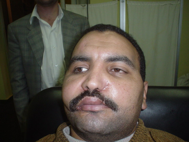 Cosmetic Surgery Egypt,Plastic Surgery,face trauma,fracture,mandible,Cairo