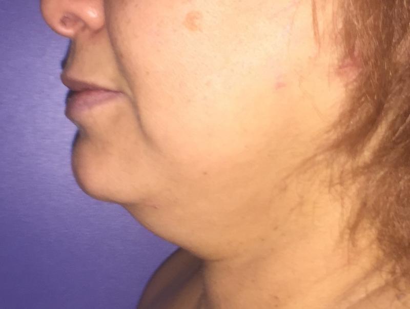 Neck vaser Liposuction, Neck Laser Liposuction, Jaw Line, Neck Lift, cosmetic 
