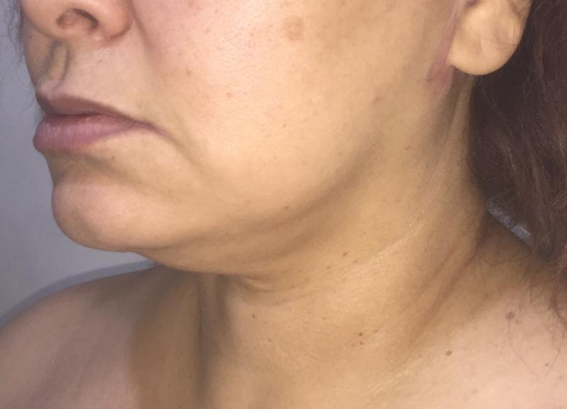 Neck vaser Liposuction, Neck Laser Liposuction, Jaw Line, Neck Lift, Plastic