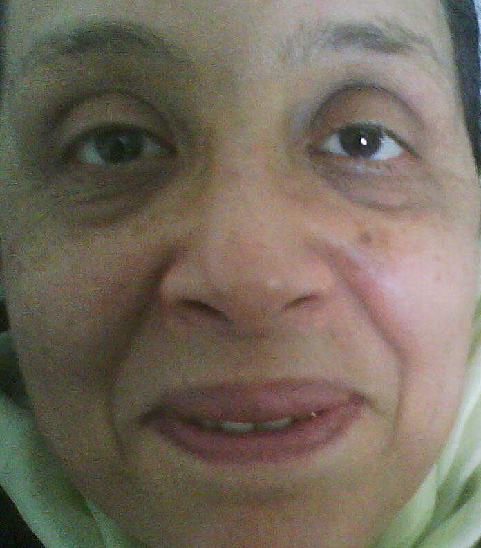 aesthetic surgery egypt,face lift,Laser,fractional,wrinkle,plastic surgery