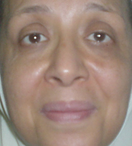 Cosmetic surgery,Egypt,Plastic surgery,Liposuction,laser,face wrinkle,face lift