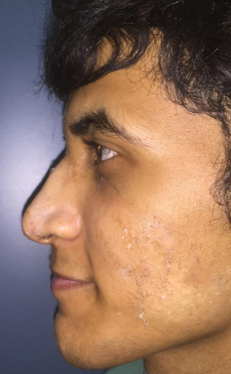 Nose surgery, Hump removal, Nose dorsum, Nose tip raising, Aesthetic Rhinoplasty