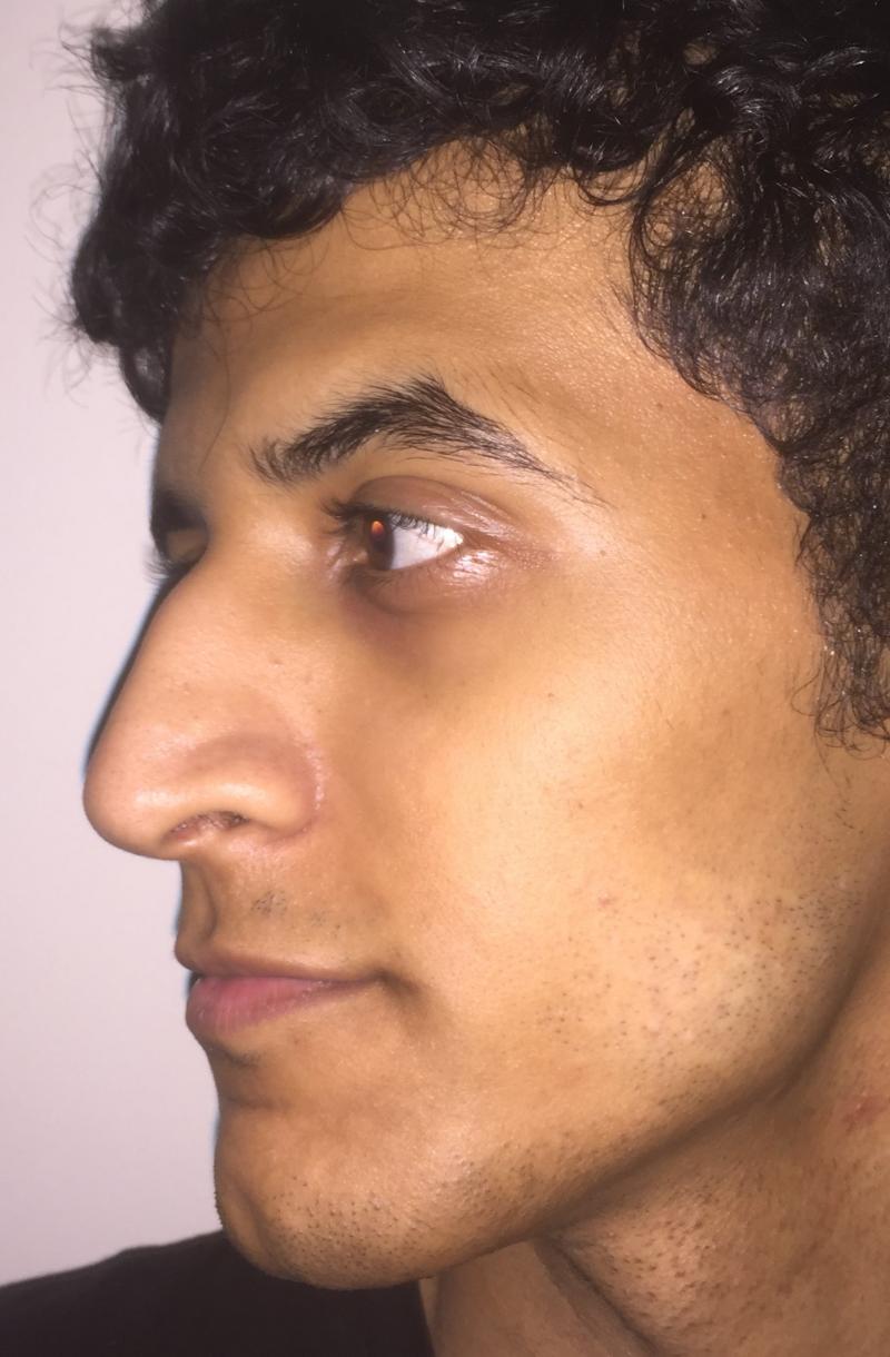 Nose surgery, Hump removal, Nose dorsum, Nose tip raising, Cosmetic Rhinoplasty
