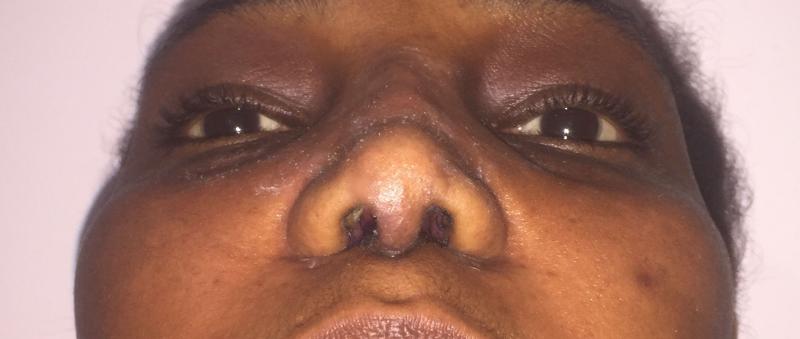 African Nose Job, Rhinoplasty, Wide tip, Nasal Tip, Broad nose Best Cosmetic Sur