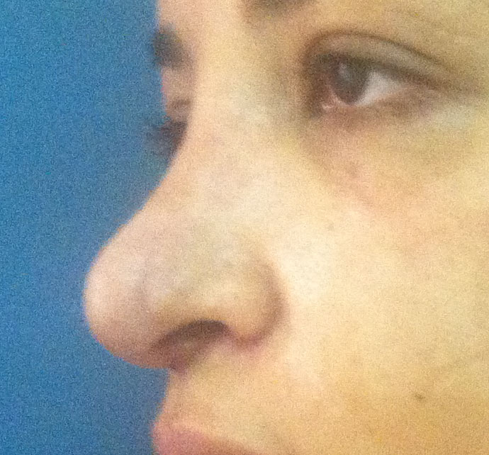 Rhinoplasty, Nose Job, Wide Tip, Boxy Tip, Dorsal Hump, Best Cosmetic Surgery