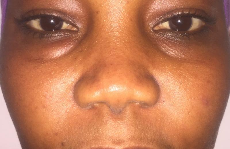 African Nose Job, Rhinoplasty Primary, Wide tip, Nasal Tip, Best Cosmetic Surger