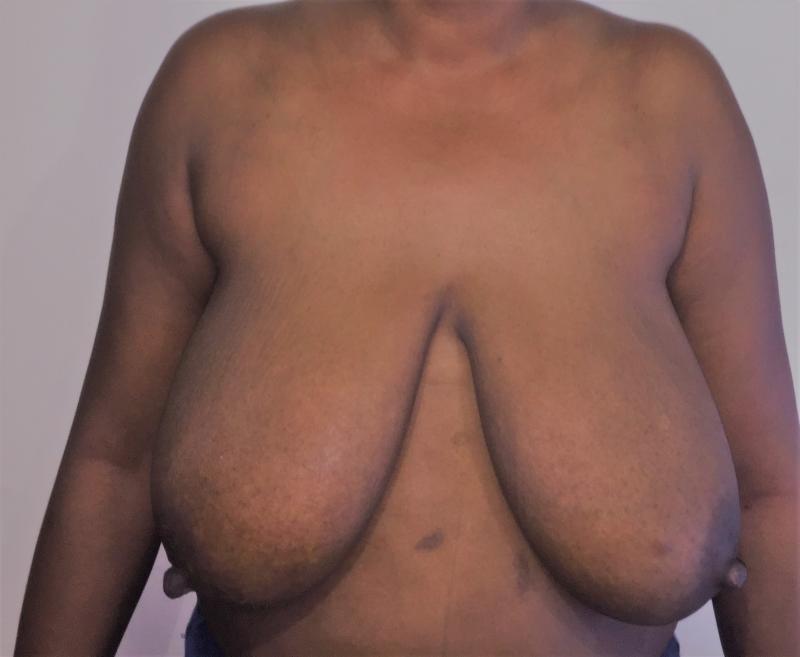 Breast Reduction, Breast Lift, Mastopexy, Reduction Mammoplasty, Cosmetic Surger