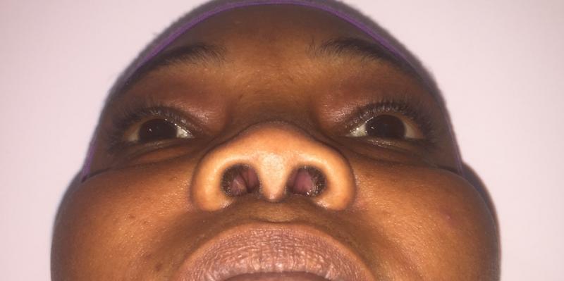 African Nose Job, Rhinoplasty, Wide tip, Nasal Tip, Broad nose Best Plastic Surg