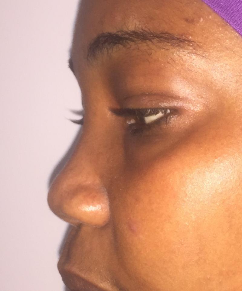 African Nose Job, Rhinoplasty Primary, Wide tip, Nasal Tip, Best Aesthetic Surge