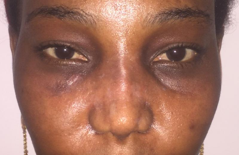 African Nose Job, Rhinoplasty Primary, Wide tip, Nasal Tip, Best Plastic Surgery