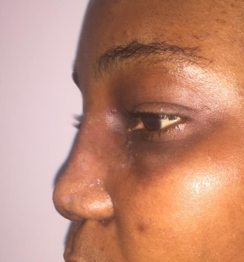 African Nose Job, Rhinoplasty, Wide tip, Nasal Tip, Broad nose Best Aesthetic Su