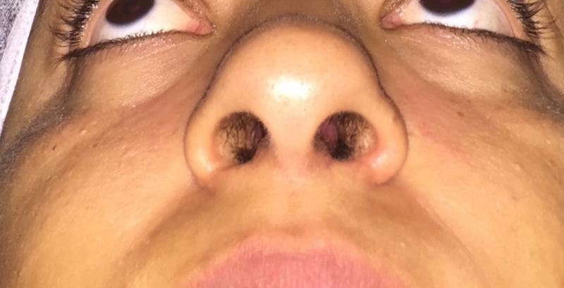Rhinoplasty, Nose Job, Wide Tip, Boxy Tip, High Tip, Hump, Best Cosmetic Surgery