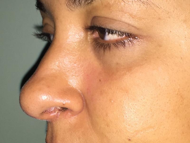 Rhinoplasty, Nose Job, Wide Tip, Boxy Tip, High Tip, Hump, Best Aesthetic Surger