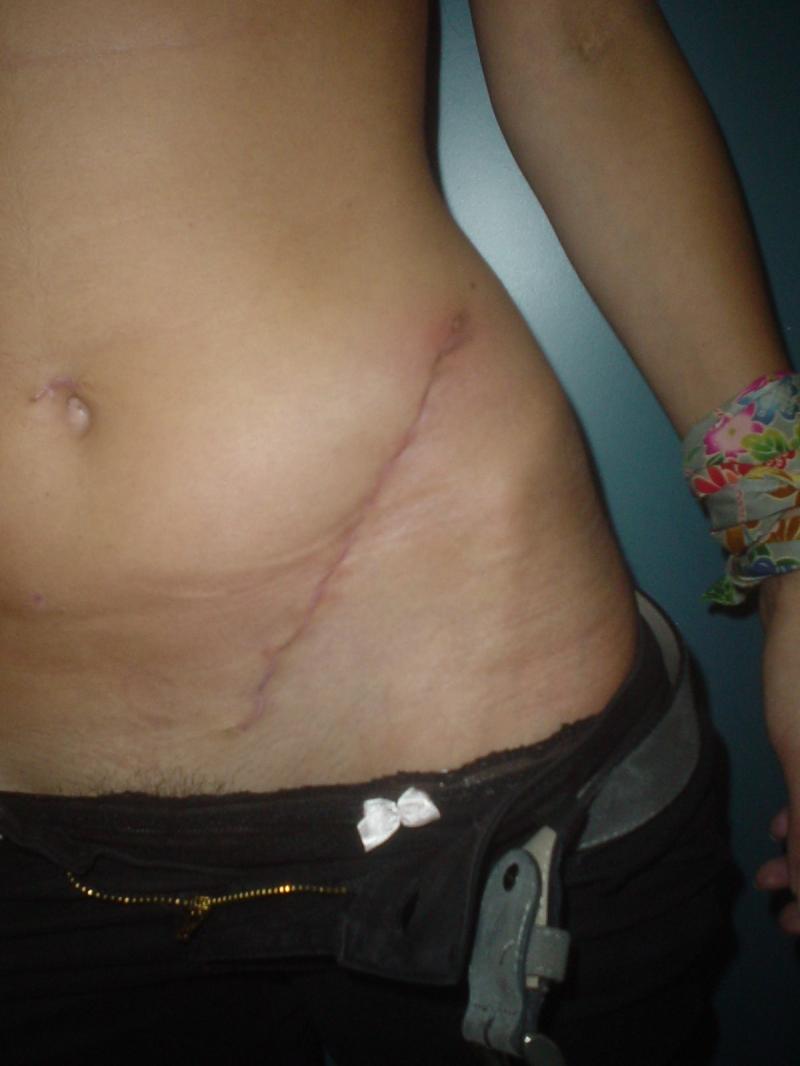 Plastic Surgery in Egypt, Tattoo Removal, Surgery, Cosmetic Surgery in Egypt